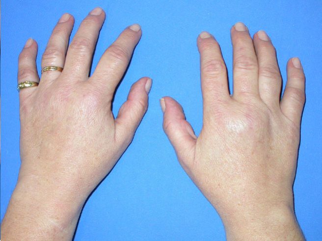 Rheumatoide Arthritis